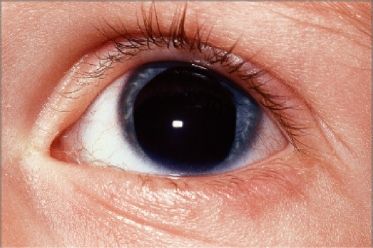 aniridia, consult oftalmologic, doctor