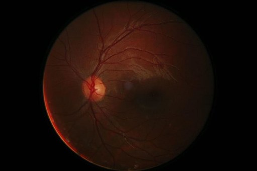 Tipuri de edem macular
