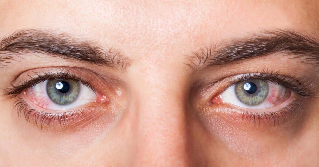 Toxocaroza oculară - ochi, roșeață
