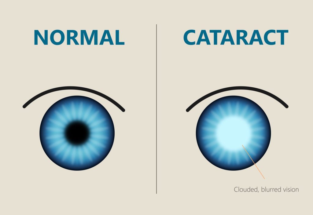 cataracta simptome