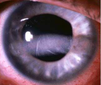 keratopatia in banda