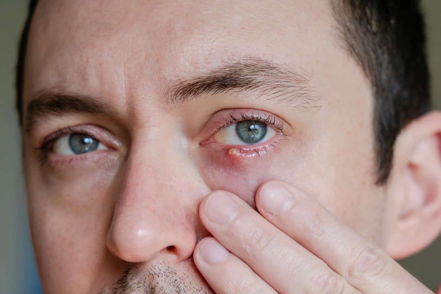 chalazion, ochi albastru, fata